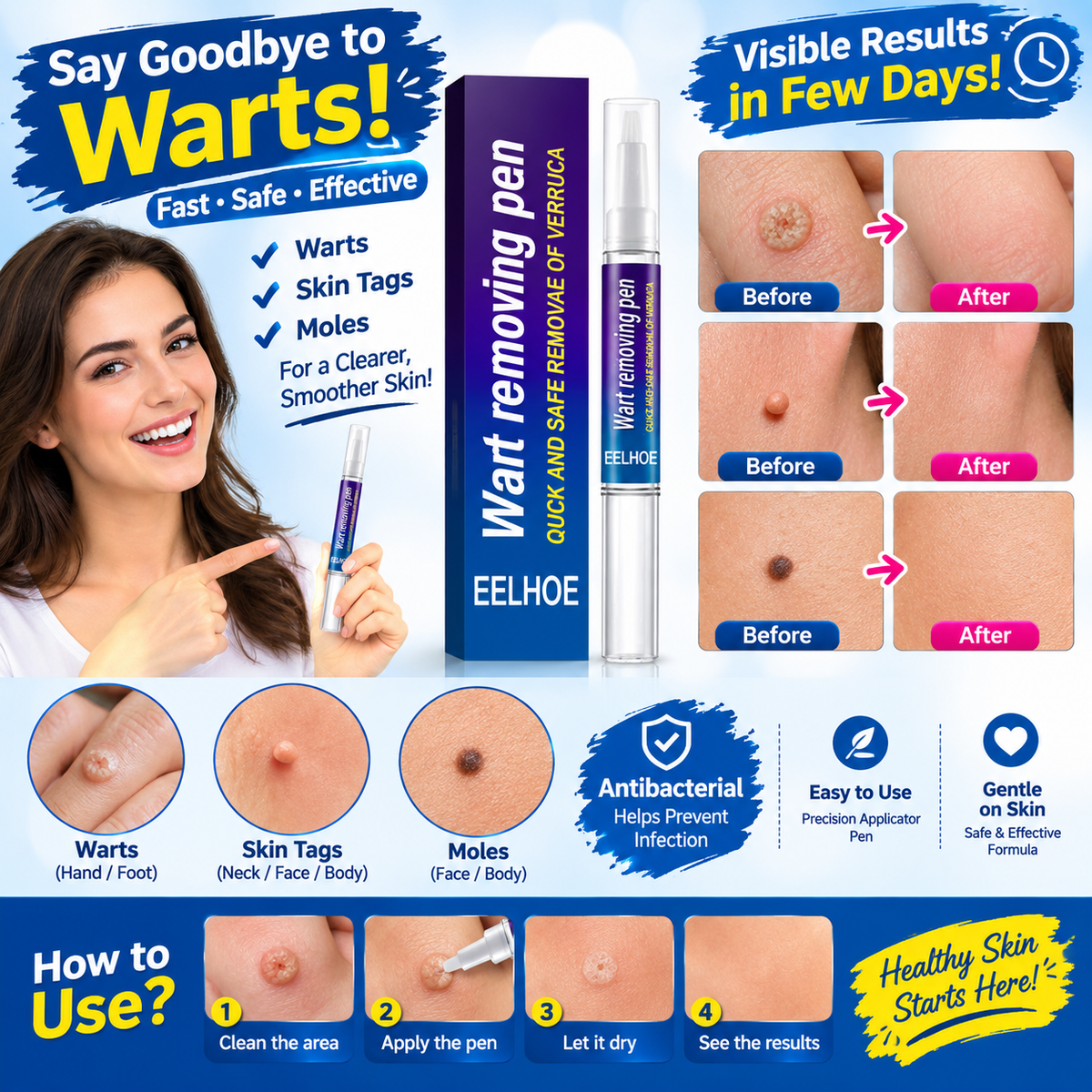 Wart Remover Gel Pen – Targeted Wart Care Treatment for Hands & Feet