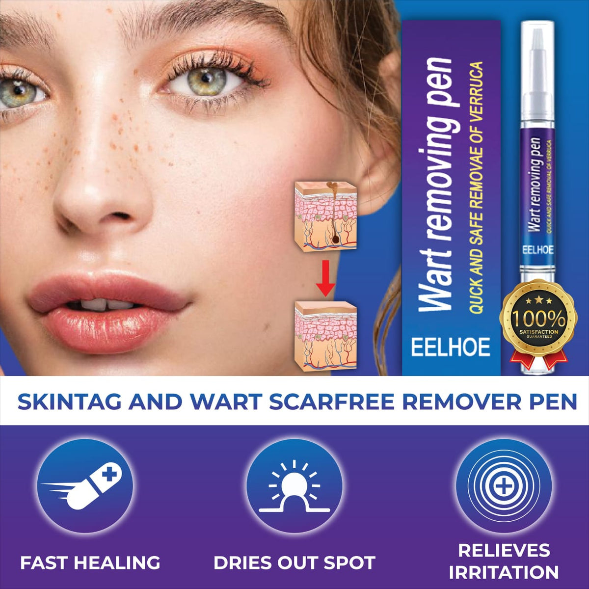 Wart Remover Gel Pen – Targeted Wart Care Treatment for Hands & Feet